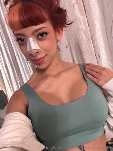 Post op update i m healing really nicely and i hope i can get back to part 3