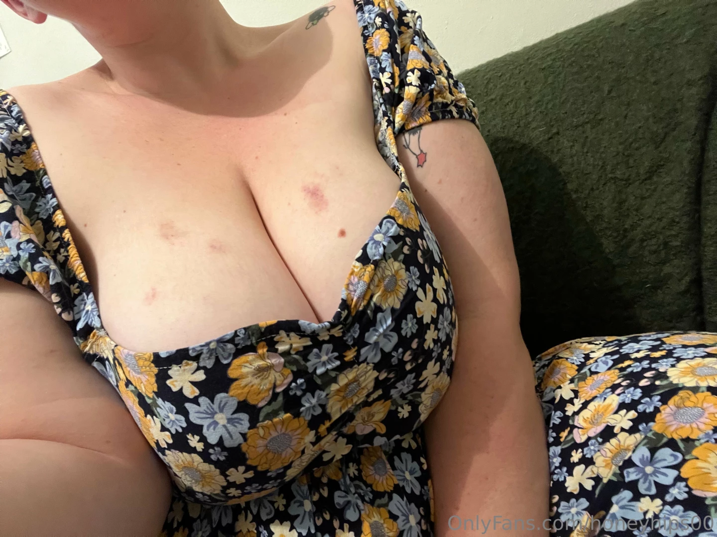 How do we feel about bruises drop me a message to let me know or a tip 