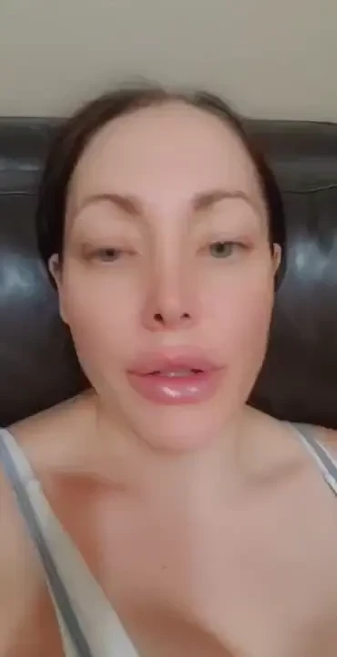 This is how they look right after injections i need another fill if 