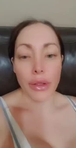 This is how they look right after injections i need another fill if