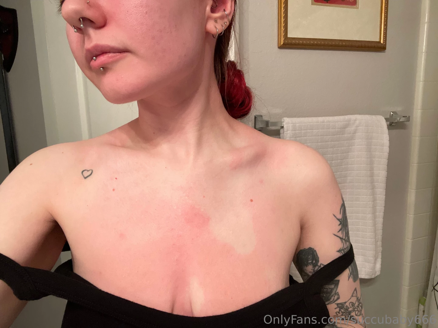 Update it spread to my face and eyes so i visibly do not look like part 2 