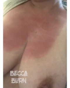 How about some lotion for that burn
