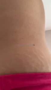 Stretch marks don t bother you do they