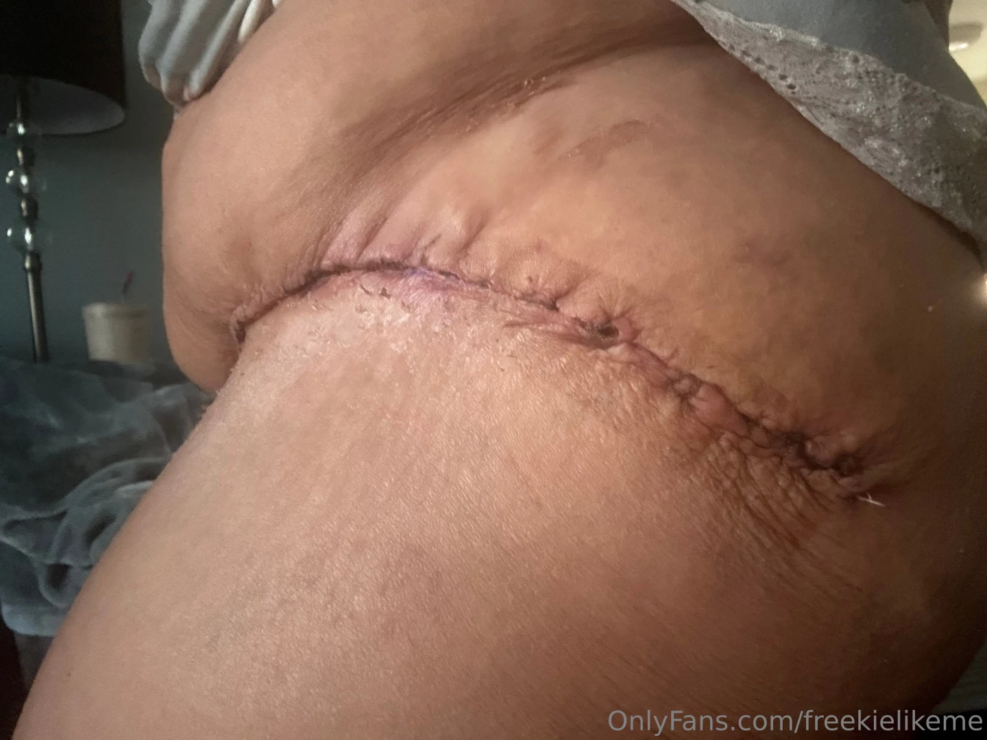 Loving the skin i m in flaws scars and all at 52 i embrace every part 1 