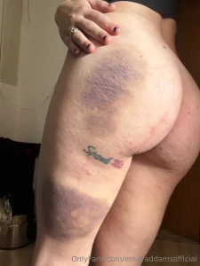 Scratchies and bruisies today