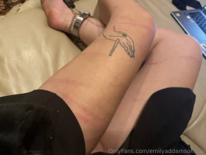 Scratchies and bruisies today part 1