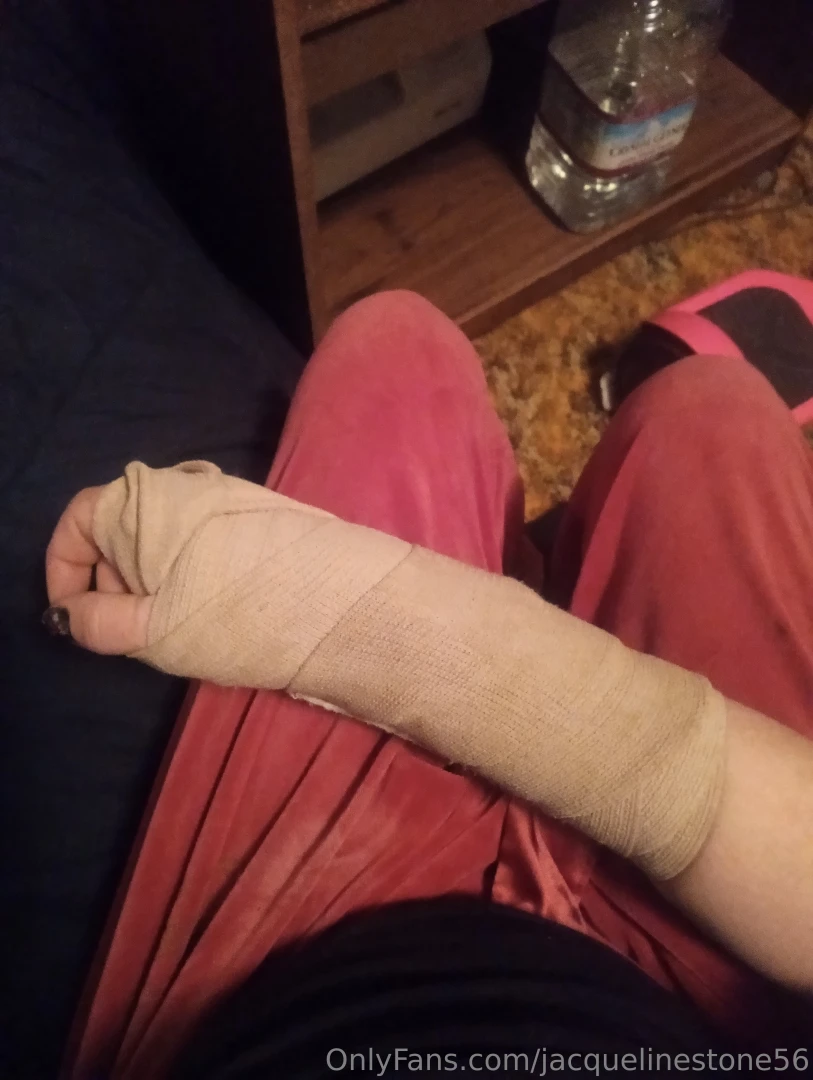 Definitely broke my wrist on a hover board tonight 