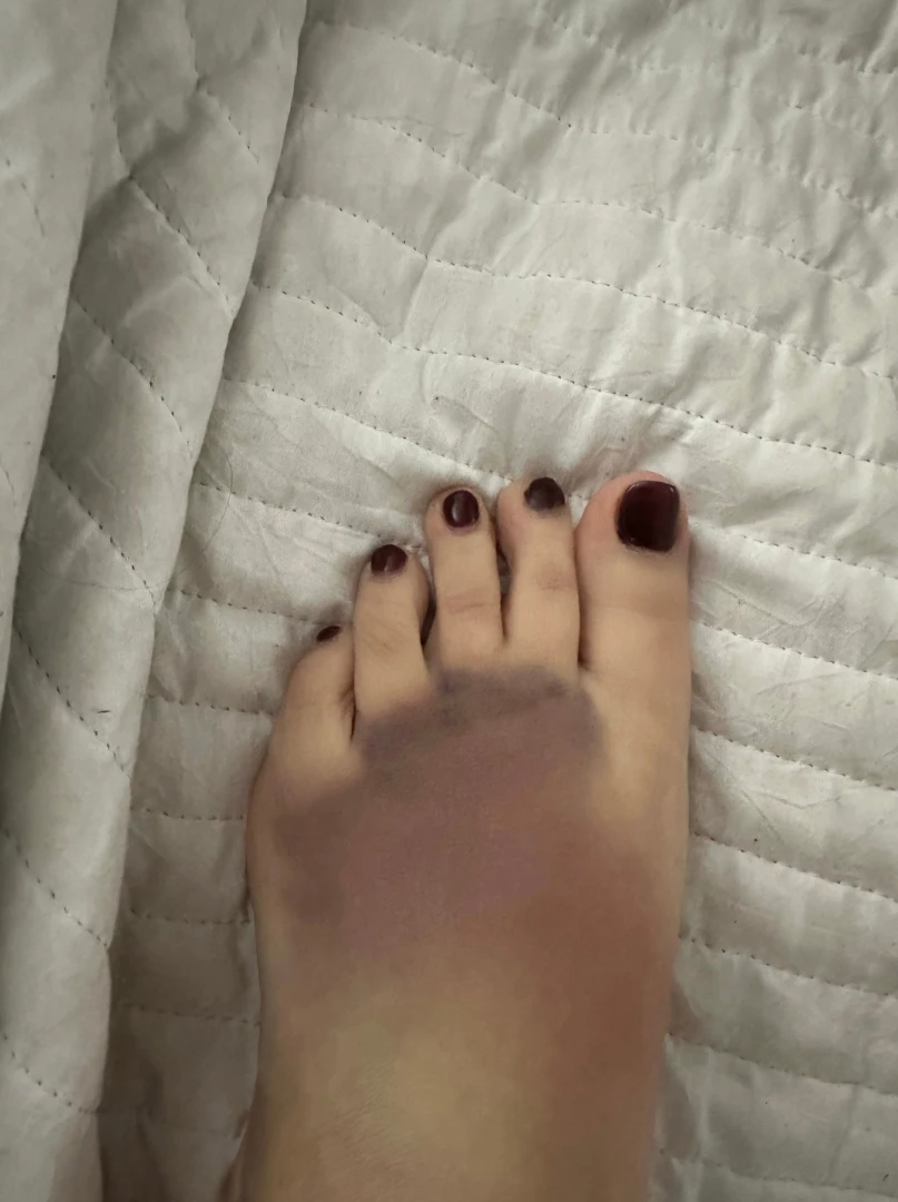Hello a little update for you all i have been mia since i fell down part 2 