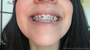 Not a wedgie but i did get braces today y or n